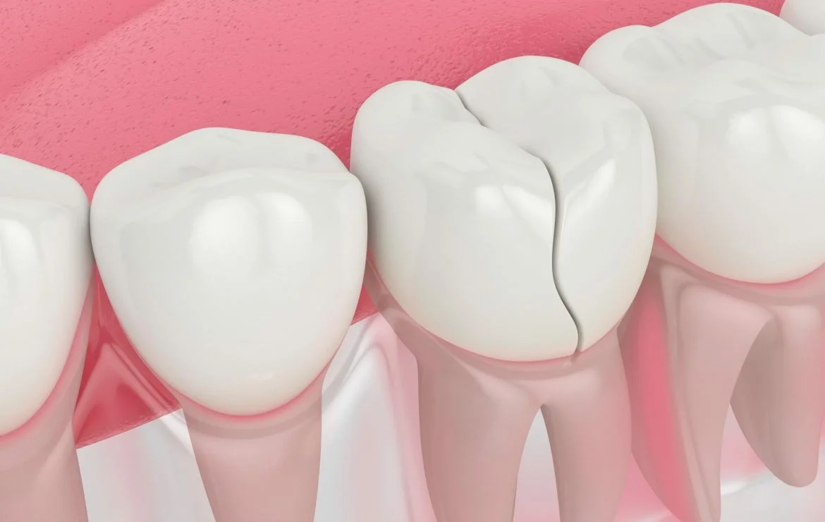 chipped or fractured teeth repair in downtown edmonton