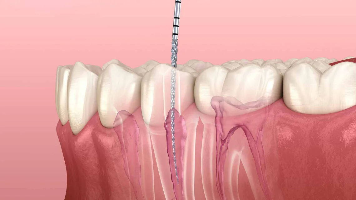 emergency root canal in downtown edmonton