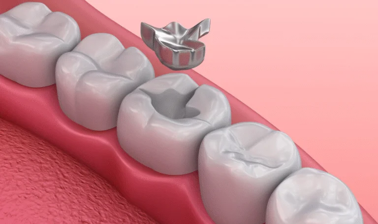 lost or loose fillings & crowns in downtown edmonton