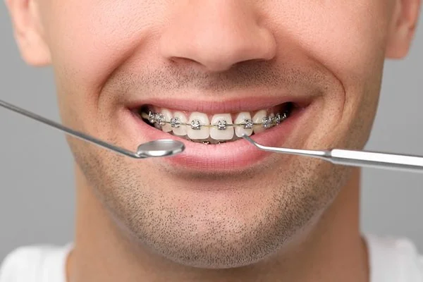 orthodontic maintenance in downtown edmonton