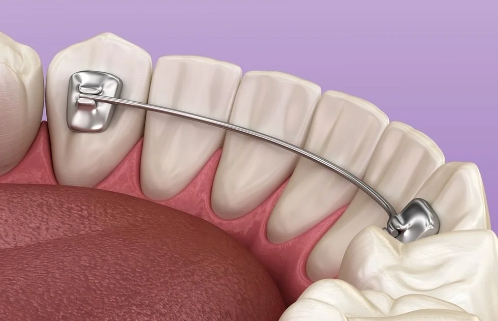 orthodontic retainers in downtown edmonton