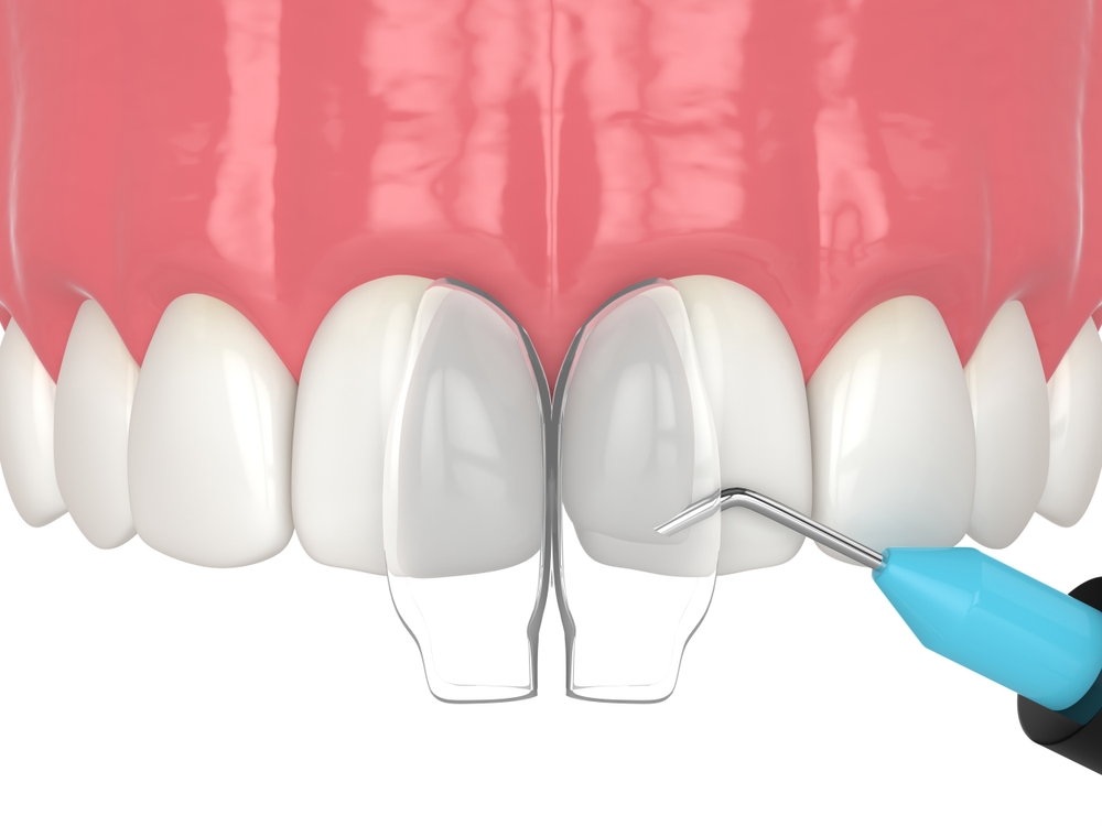 dental bonding vs veneers which cosmetic option is right for you