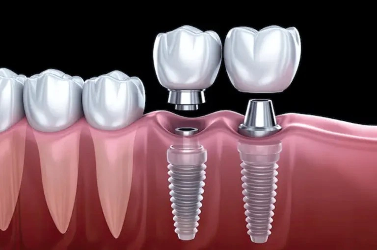 Dental Implant Aftercare: Tips for a Smooth Recovery