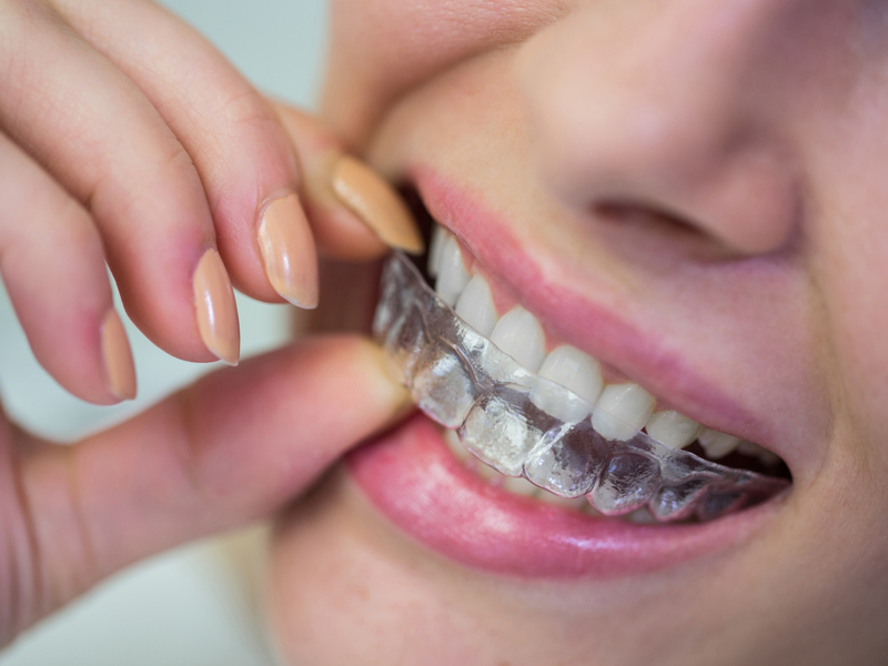 How to Care for Your Invisalign Aligners Properly