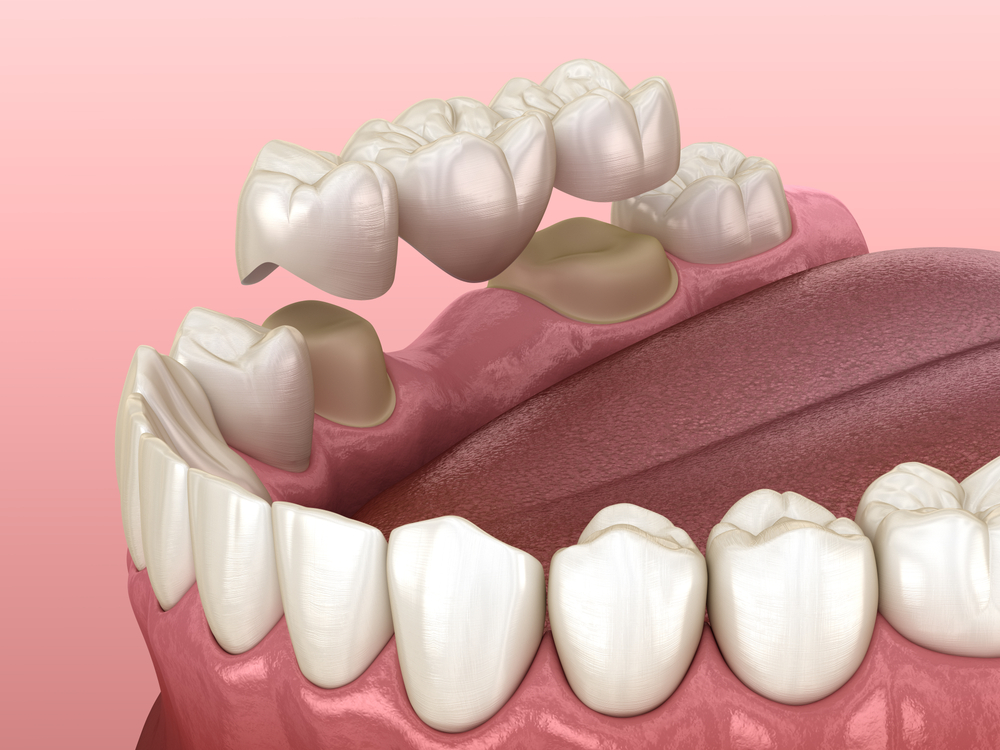 dental crowns