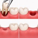 How Long Does it Take to Recover from a Tooth Extraction?