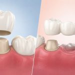 How Do Crowns and Bridges Differ